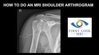 How to do an MRI shoulder arthrogram [upl. by Aram403]