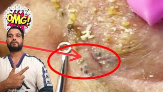 blackhead extraction  nose blackheads removal  nose blackhead [upl. by Youlton]