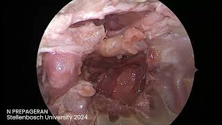 Module 10 Endoscopic Transclival approach and review of anatomy [upl. by Deron]