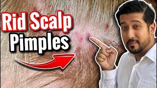 Scalp Pimples Removal  5 Fast and Easy Ways to Get Rid of Scalp Pimples [upl. by Enneira587]