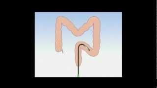 Double balloon colonoscopy [upl. by Solley]