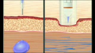 Needle VS Needle Free Injection [upl. by Haisa451]