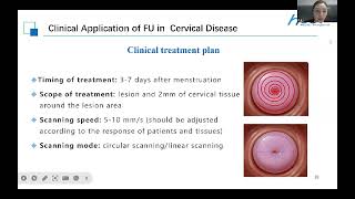 Focused Ultrasound for Cervical Intraepithelial NeoplasiaCIN [upl. by Iver]