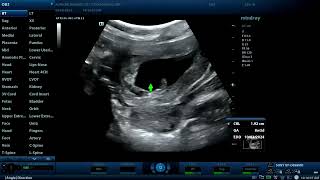 Non viable embryo with retroplacental hematoma Diagnostic ultrasound cases [upl. by Odab]