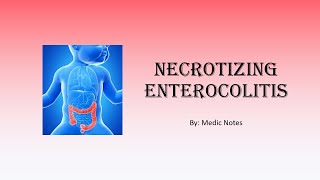 Necrotizing enterocolitis  definition clinical features investigations management [upl. by Ahsaek]