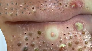 Big Cystic Acne Blackheads Extraction Blackheads amp Milia Whiteheads Removal Pimple Popping  703 [upl. by Skurnik]