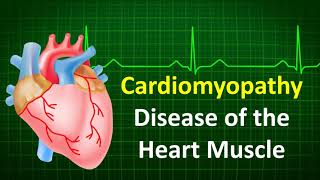 Cardiomyopathy Disease of the Heart Muscle [upl. by Nnalyrehc]