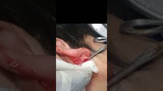 Ear lobule cyst  pus inside cyst  shorts [upl. by Joost185]