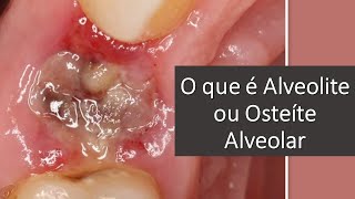 O que é Alveolite ou Osteíte Alveolar  Odontologia  Dra Bianca Rosa [upl. by Tnecnev]