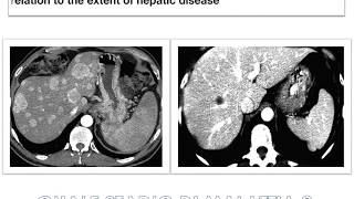 Surgical treatment of liver metastasis of neuroendocrine tumors NETs [upl. by Eecyak306]