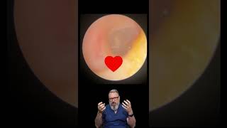 ROCK SOLID EAR WAX REMOVAL  EP975 earcare [upl. by Letsou]