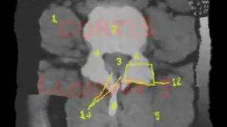 ANATOMIA BASICA EN EL TAC LUMBO  SACRO  RADIOLOGIA [upl. by Alleahcim495]