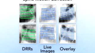 Spinal Tumor Treatment Process  Motion Correction  Orange County CyberKnife [upl. by Daahsar]