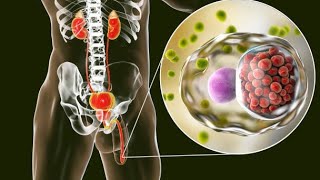 Chlamydia  Comprendre Diagnostiquer et Soigner [upl. by Riesman442]