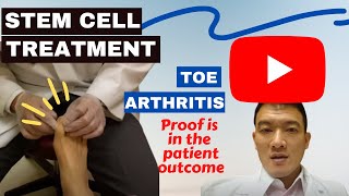 Stem cell treatment and toe arthritis  Florida Podiatrist [upl. by Leong]