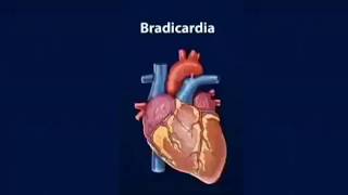 Tachycardia Bradycardia [upl. by Burkhardt]