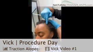 High Hairline Solution Hair Transplant Transforms Patients Hairline  Dr Blumenthal Vick [upl. by Firmin]