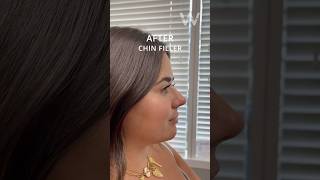 Before and immediately after chin filler injections with Dr Wise in Wayne NJ [upl. by Brandise]