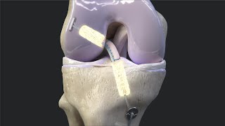 Arthrex BioACL™ Technique [upl. by Towrey78]