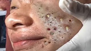 Big Cystic Acne Blackheads Extraction Blackheads amp Milia Whiteheads Removal Pimple Popping  701 [upl. by Querida]