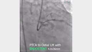 ENDOSTENT Sirolimus Eluting Coronary Stent System [upl. by Ladd]