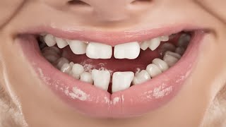 Why Straight Teeth Matter  How Can Crooked Teeth Affect Your Oral Health [upl. by Guarino33]