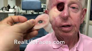 Eye Prosthesis with Orbital and Sinus Cavity Prosthesis RealLifeFaces [upl. by Critchfield]