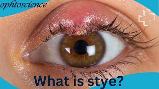 Stye How to get rid of stye fast stye or Chalazion [upl. by Nnaeerb]