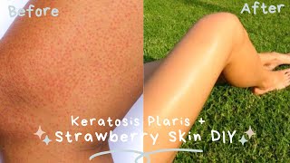 GET RID OF STRAWBERRY LEGS  KERATOSIS PILARIS  DARK SPOT REMOVAL My At Home Remedy Cure  DIY [upl. by Ytsirhk]