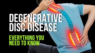 Degenerative Disc Disease  Everything You Need to Know [upl. by Holleran]