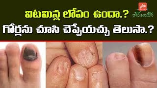 విటమిన్ల లోపమా గోర్లను చూసి చెప్పేయచ్చు  Vitamin Deficiency Can be Noted by Nails  YOYO TV Health [upl. by Swift]