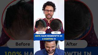 100 Hair Regrowth in 4 Months  Hair Loss  Hair Regrowth  Hair Fall  Adon Hair Care viral [upl. by Addi287]