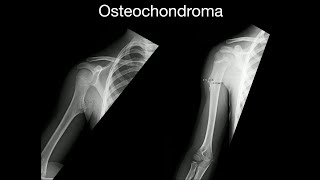 Osteochondroma [upl. by Eserrehs476]