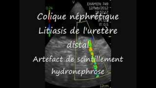 Vscan Calculs uretère distal Artefact scintillement Hydronephrose [upl. by Imre]