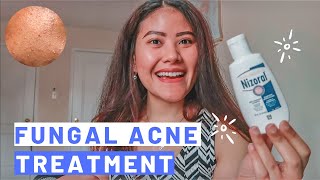 2 WEEKS MALASSEZIA FOLLICULITISFUNGAL ACNE TREATMENT  How to Get Rid of Fungal Acne Fansi Lantana [upl. by Mandell]