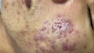 Blackheads amp Whiteheads Removal On Chin Boy 2024 Acne Treatment With Nhat Bang [upl. by Ianthe]