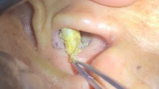 japanese ear cleaning asmr 耳垢を取る rái tai bị đầy bít lổ tai earwax earwaxcleaner earwaxremoval [upl. by Saffier170]