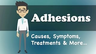 Adhesions  Causes Symptoms Treatments amp More… [upl. by Sherrill]