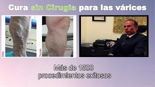 Cura para venas varices SIN CIRUGIA en Bogota Colombia  Tratamiento Ulceras varicosas Linfedema [upl. by Nair]