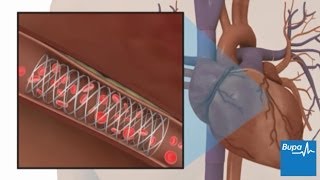 How coronary angioplasty is carried out  Bupa Health [upl. by Garnett176]