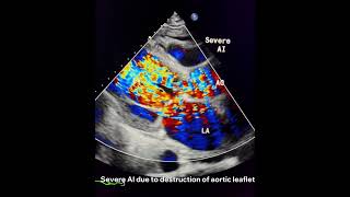 Infective Endocarditisto drahmadmirdamadisiy66XFU4h2QChqFiV [upl. by Anitselec]