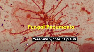 Heavy load of fungus in Sputum Microscopy [upl. by Attaynek]