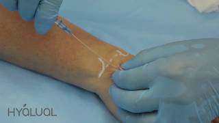 Monaco 2017  Hand Rejuvenation Using Rederm From Hyalual [upl. by Mccollum92]