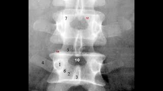 Radiological Anatomy of the Lumbar Spine Xray MRI amp CT Covered [upl. by Marilin990]