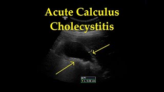 Acute Cholecystitis with Cholelithiasis  Ultrasound  Case 18 [upl. by Nnyled]