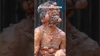 TUMORES EN TODA LA PIEL  NEUROFIBROMATOSIS [upl. by Araas]