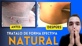 ¿Cómo REVERTIR la RESISTENCIA A LA INSULINA Y SUS SÍNTOMAS   TRATAMIENTO NATURAL  ACLARAR LA PIEL [upl. by Ger169]