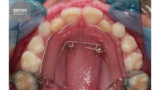 Morphing  Orthodontic maxillary expansion with Quad Helix [upl. by Llerret211]