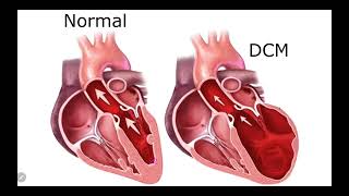 IM Cardiology 16 Cardiomyopathies Dilated cardiomyopathy DCM [upl. by Trever]