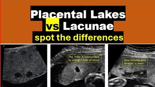 Placental lakes VS lacunae on Ultrasound [upl. by Crescen]